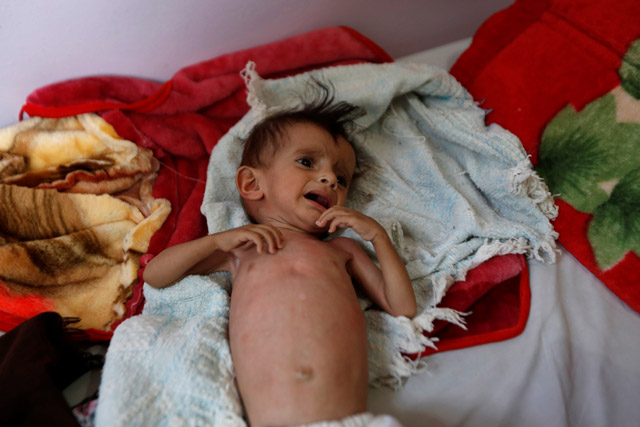 A malnourished child cries at a malnutrition treatment centre in Sanaa, Yemen, on Monday  (Reuters photo)