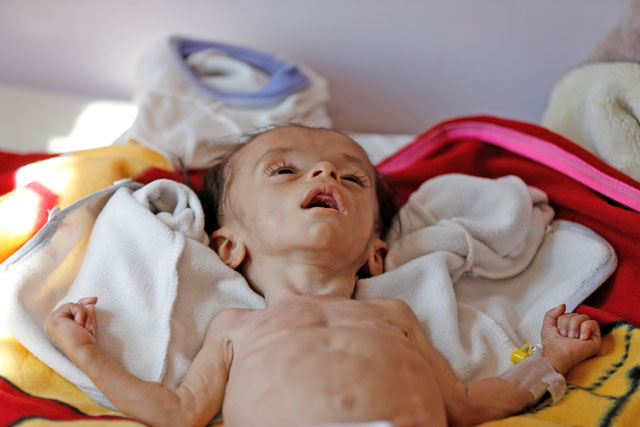 A malnourished boy lies on a bed at a malnutrition treatment centre in Sanaa, Yemen, on Tuesday (Reuters photo)
