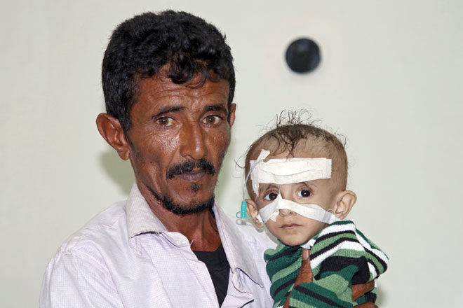 Adel Al Dhanbari holds his one-year-old son Sameer, who suffers from severe malnutrition, at a hospital in Houta city, in the southern province of Lahej, Yemen, on December 5 (Reuters photo)