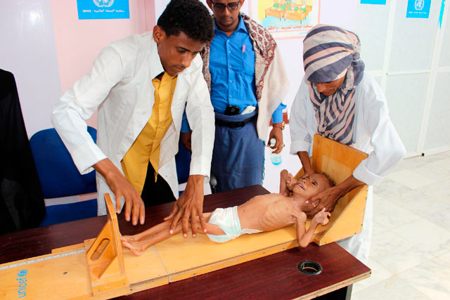 A Yemeni child suffering from malnutrition is measured at a hospital in the district of Aslam in the north-western Hajjah province on Friday (AFP photo)