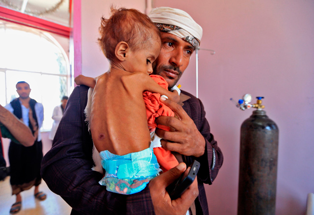A Yemeni man carrying his child who is suffering from malnutrition into a treatment centre at a hospital in the capital Sanaa on October 6  (AFP photo)