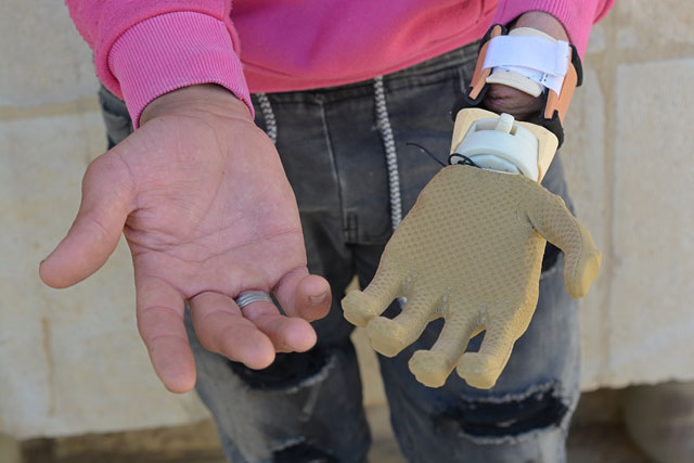 Muhammad Nasser Kennan shows the prosthetic hand supplied to him by Mand.ro, a Korean startup company with a humanitarian initiative   (Photos by Mina Mohit)