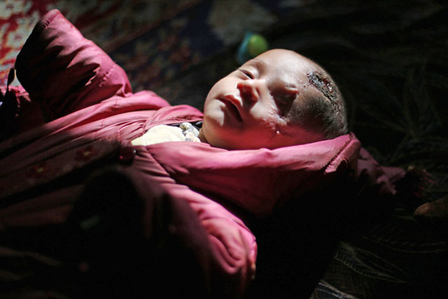 This photo taken on December 4 shows Syrian baby Karim Abdallah who lost his left eye and his mother in government shelling on the nearby town of Hammouria, in the rebel-held town of Beit Sawa, in the eastern Ghouta region, on the outskirts of the capital Damascus (AFP photo)