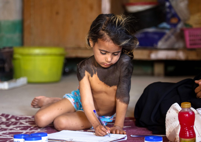 Haura, a four-year-old Iraqi child with a rare skin congenital disease that covers much of her upper body in black marks and hair, uses a pen to scribble in a notebook in her family home in the village of Wahed Haziran, Diwaniya province, on April 17 (AFP photo)