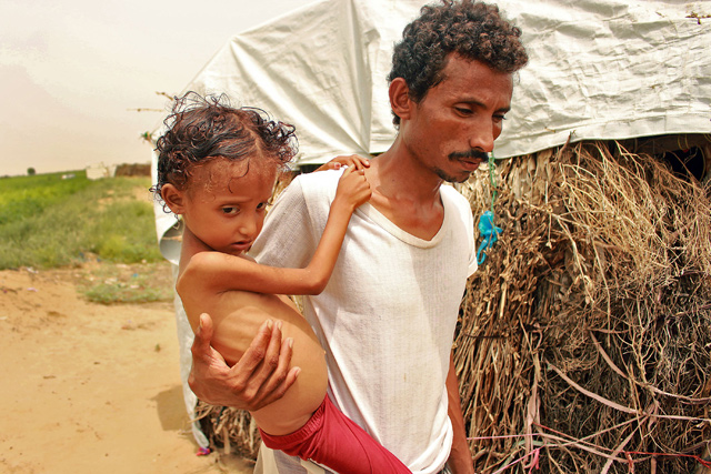 Eight-year-old displaced Yemeni girl, Samar Ali Ahmed, weighing nine-and-a-half kilogrammes and suffering from acute malnutrition, is photographed in Hajjah Governorate, in northern Yemen, on Wednesday (AFP photo)