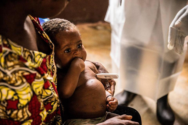 A  woman and her child, both infected with monkeypox await treatment at the quarantine of the centre of the International medical NGO Doctors Without Borders (Medecins sans frontieres - MSF), in the Central African Republic (AFP photo)