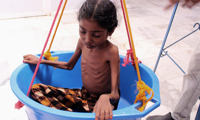 A Yemeni child suffering from severe malnutrition is weighed at a treatment centre in a hospital in Yemen’s northwestern Hajjah province, on October 25  (AFP photo)