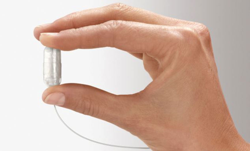 A new gastric balloon procedure sees patients swallow a capsule (pictured) which contains a deflated balloon which is attached to a tube  (Photo courtesy of Obalon)