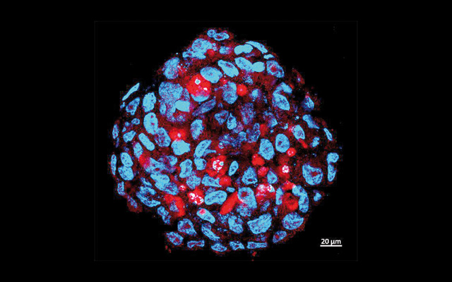  Tumour sphere comprised of human medulloblastoma stem cells infected by Zika (red) (Photo courtesy of genengnews.com)